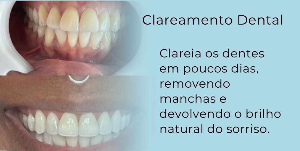 dr-erival-santana-clareamento-dental