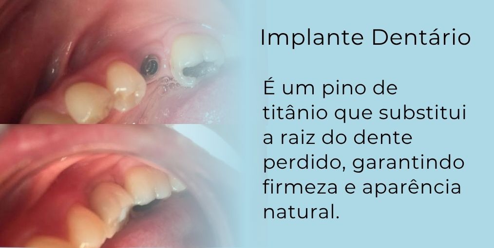 dr-erival-santana-implante-dentário